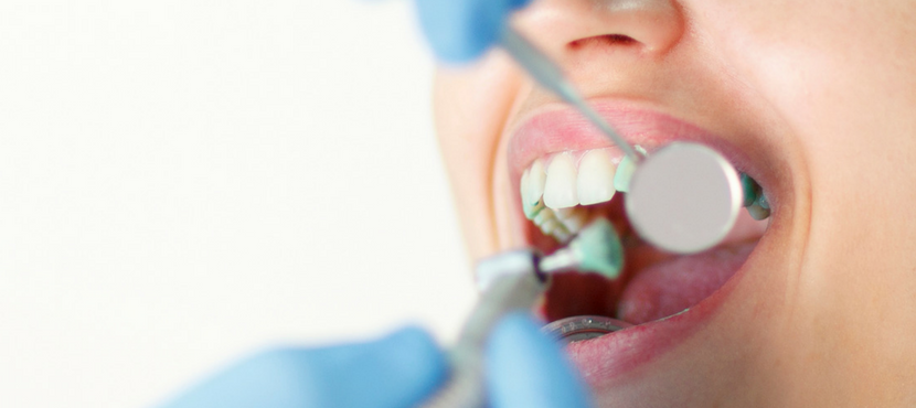 Čišćenje zubnog kamenca