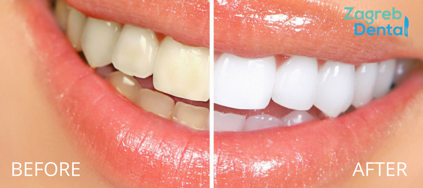 Zoom teeth whitening