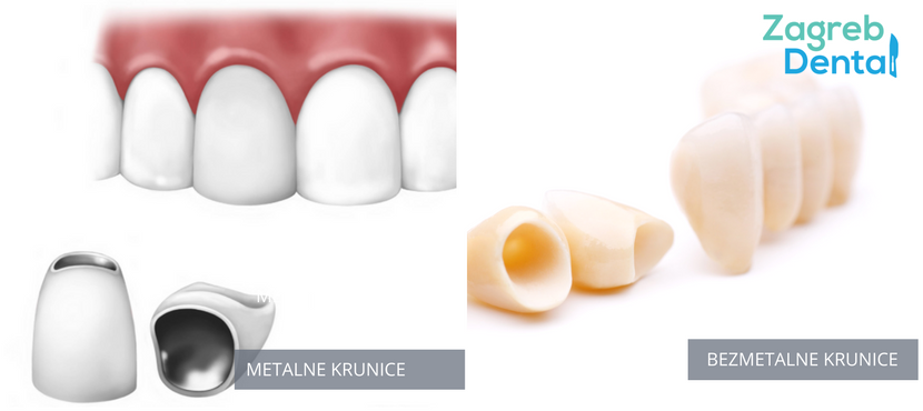 vRSTE KERAMIČKIG KRUNICA